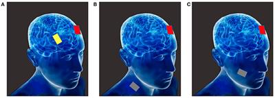 Modulation of Brain Activity with Noninvasive Transcranial Direct Current Stimulation (tDCS): Clinical Applications and Safety Concerns